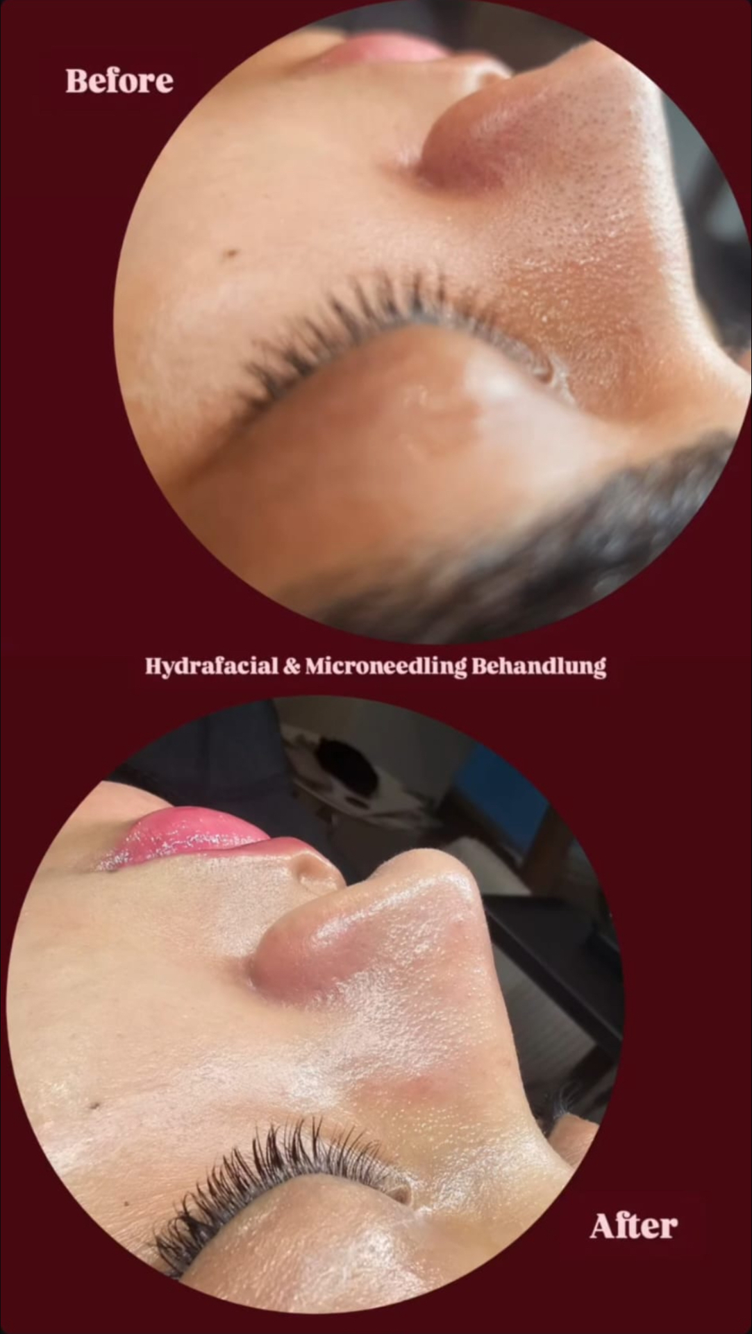 Hydrafacial & Microneedling