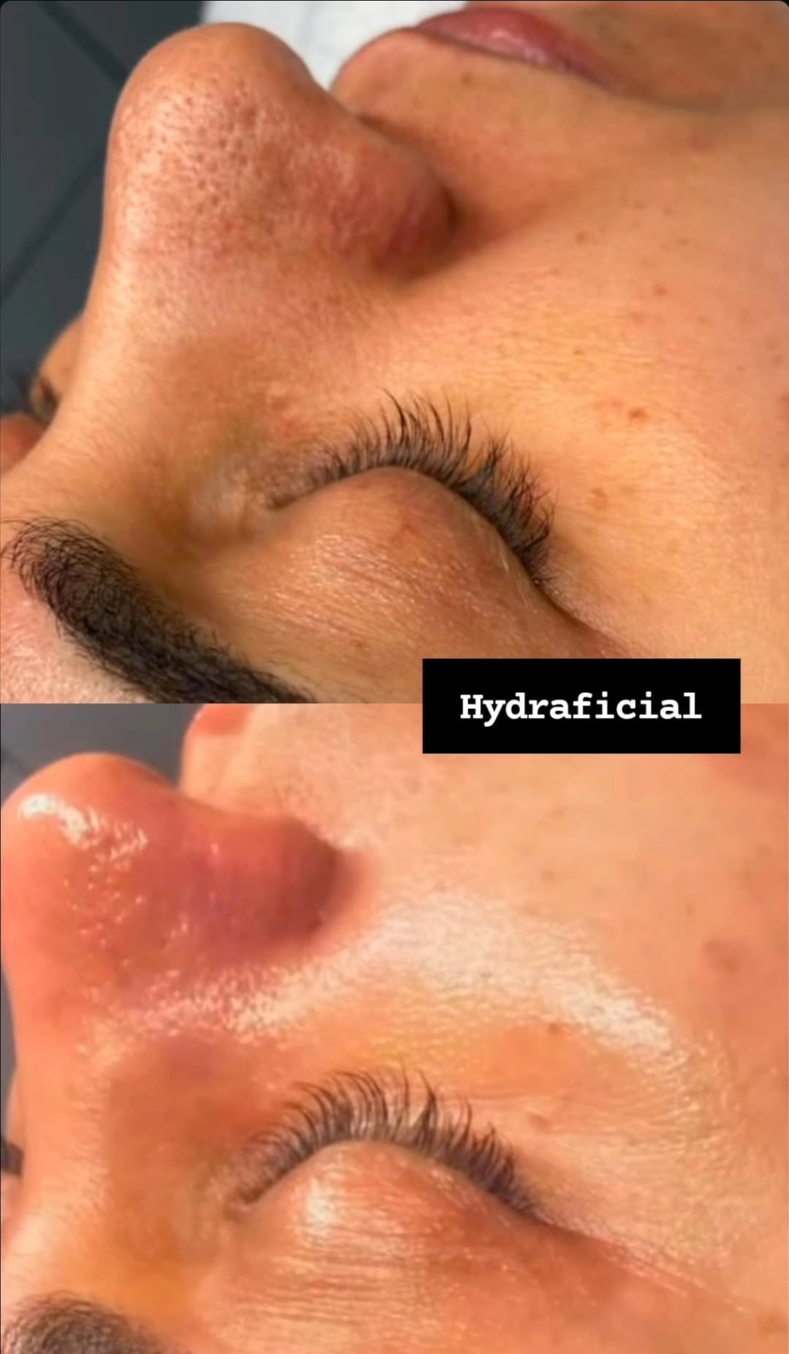 Hydrafacial